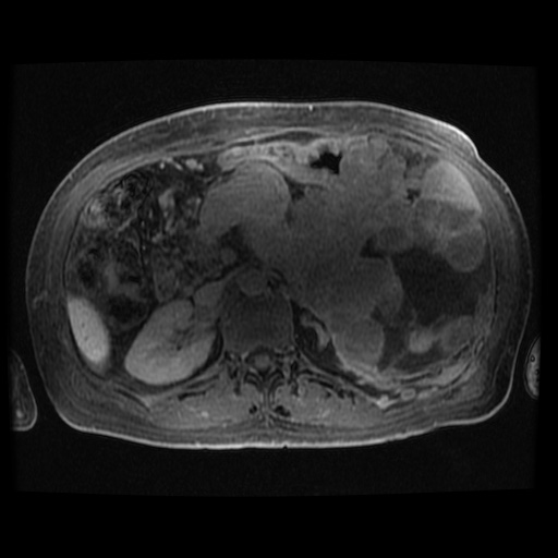 Acinar cell carcinoma of the pancreas (Radiopaedia 75442-86668 Axial late phase (~30 mins) 52).jpg
