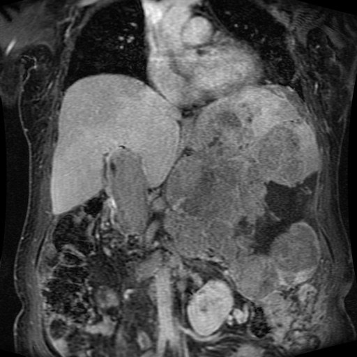 Acinar cell carcinoma of the pancreas (Radiopaedia 75442-86668 Coronal T1 C+ fat sat 109).jpg