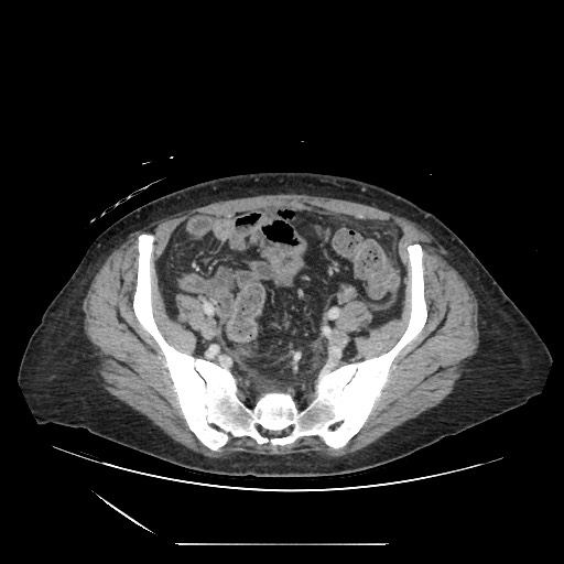 File:Acinar cell carcinoma of the pancreas (Radiopaedia 75442-86669 Axial C+ portal venous phase 114).jpg