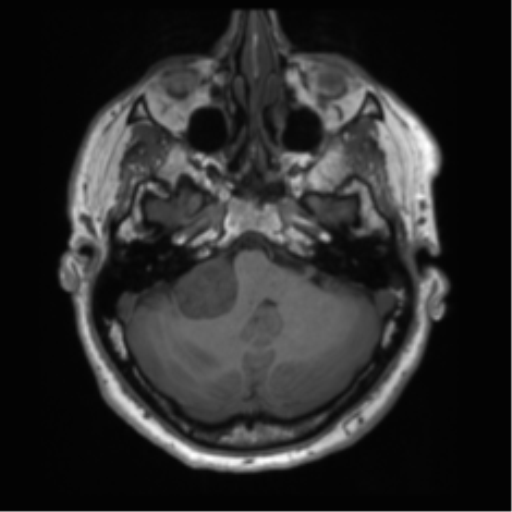 File:Acoustic schwannoma (Radiopaedia 50846-56358 Axial T1 18).png