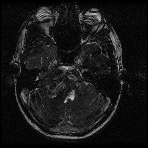 Acoustic schwannoma - eroding petrous apex (Radiopaedia 39674-42004 Axial T2 44).png