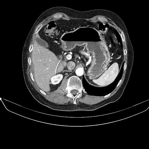 File:Acquired adrenal hyperplasia - due to thymic carcinoid tumor (Radiopaedia 21269-21184 C+ arterial phase 26).jpg