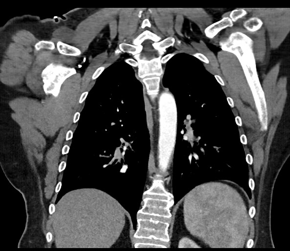File:Acromioclavicular joint cyst (Radiopaedia 58455-65610 Coronal 40).jpg