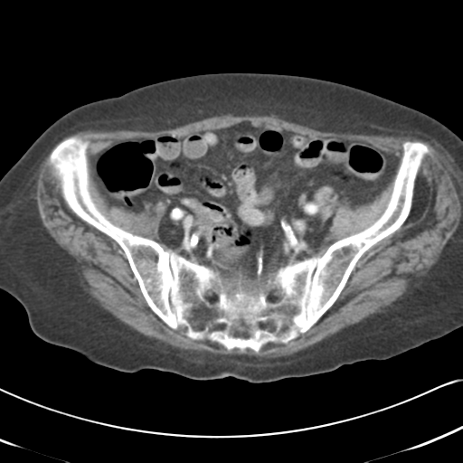 File:Active bleeding from duodenal ulcer with embolization (Radiopaedia 34216-35481 C 49).png