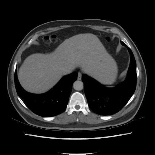 File:Active colonic bleed on CT (Radiopaedia 49765-55025 Axial C+ delayed 12).jpg