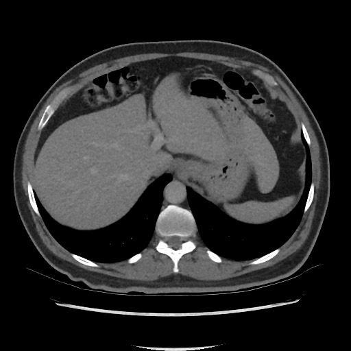 File:Active colonic bleed on CT (Radiopaedia 49765-55025 Axial C+ delayed 16).jpg