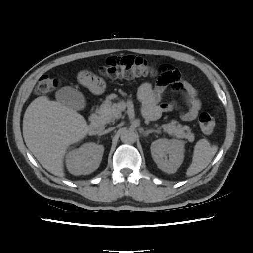 File:Active colonic bleed on CT (Radiopaedia 49765-55025 Axial non-contrast 25).jpg
