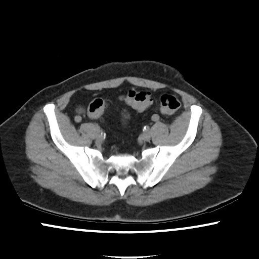 Active colonic bleed on CT (Radiopaedia 49765-55025 Axial non-contrast 65).jpg