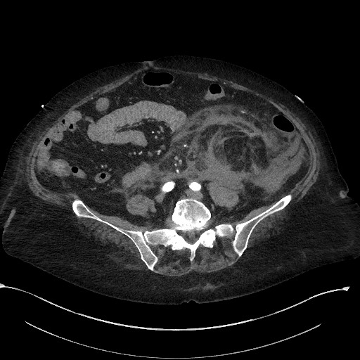 File:Active renal extravasation with large subcapsular and retroperitoneal hemorrhage (Radiopaedia 60975-68796 Axial 30).jpg