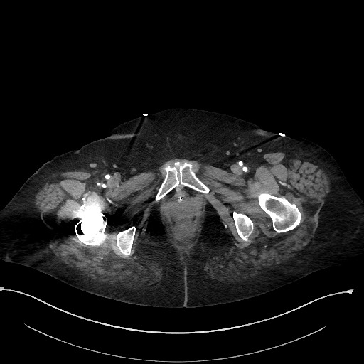 Active renal extravasation with large subcapsular and retroperitoneal hemorrhage (Radiopaedia 60975-68796 Axial C+ arterial phase 201).jpg
