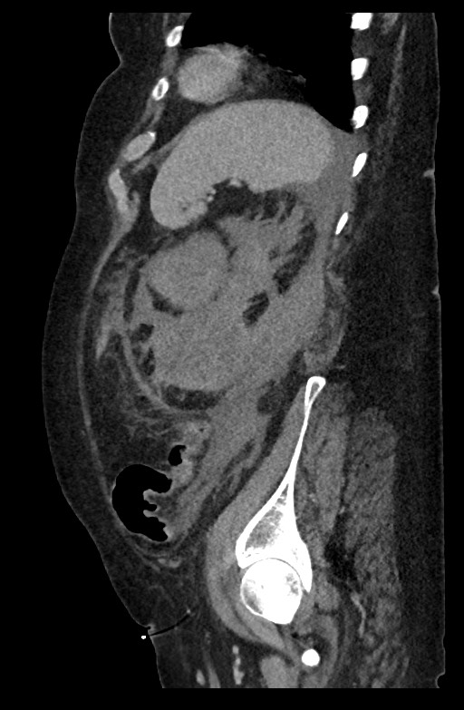 Active renal extravasation with large subcapsular and retroperitoneal hemorrhage (Radiopaedia 60975-68796 Sagittal C+ portal venous phase 67).jpg