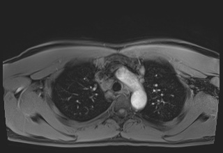 Active right ventricular cardiac sarcoidosis (Radiopaedia 55596-62100 Axial Post contrast Dixon 13).jpg