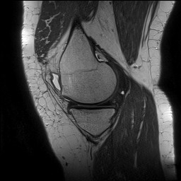 Acute-on-chronic transient lateral patellar dislocation with trochlear dysplasia (Radiopaedia 84099-99349 Sagittal PD 51).jpg
