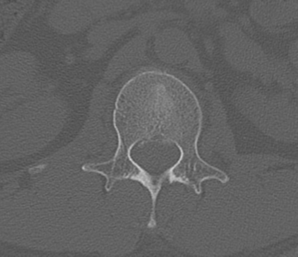 File:Acute L1 burst compression fracture (Radiopaedia 34430-35755 Axial bone window 22).png