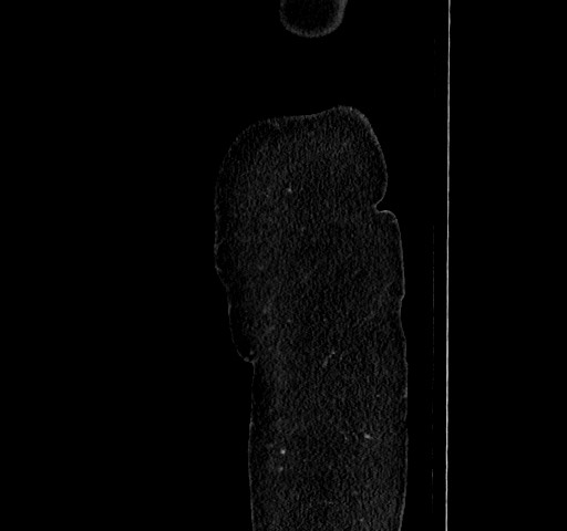 Acute appendicitis, heterotaxy syndrome (Radiopaedia 66884-76202 Sagittal C+ portal venous phase 8).jpg