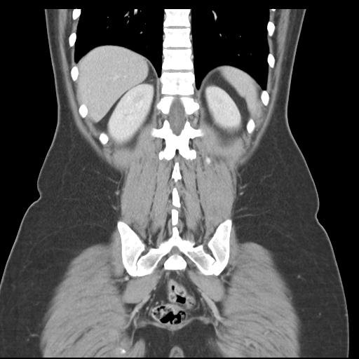 File:Acute appendicitis (Radiopaedia 30297-30934 Coronal C+ portal venous phase 37).jpg