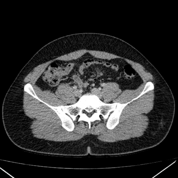 Acute appendicitis (Radiopaedia 38255-40270 Axial C+ portal venous phase 79).jpg