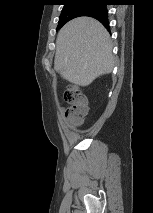 Acute appendicitis (Radiopaedia 48511-53463 Sagittal C+ portal venous phase 31).jpg