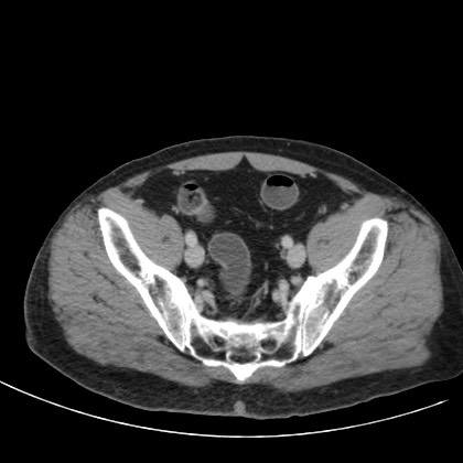 Acute appendicitis (Radiopaedia 66513-75790 Axial C+ portal venous phase 74).jpg
