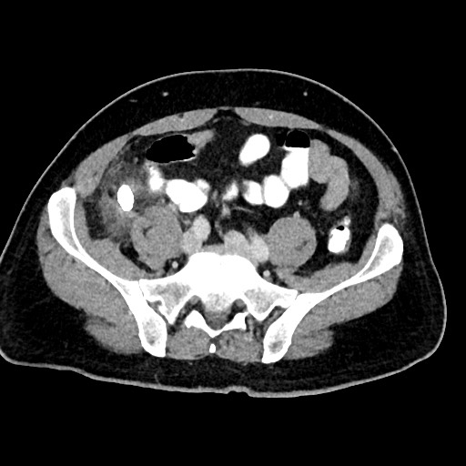 Acute appendicitis (Radiopaedia 77016-88960 Axial C+ portal venous phase 102).jpg