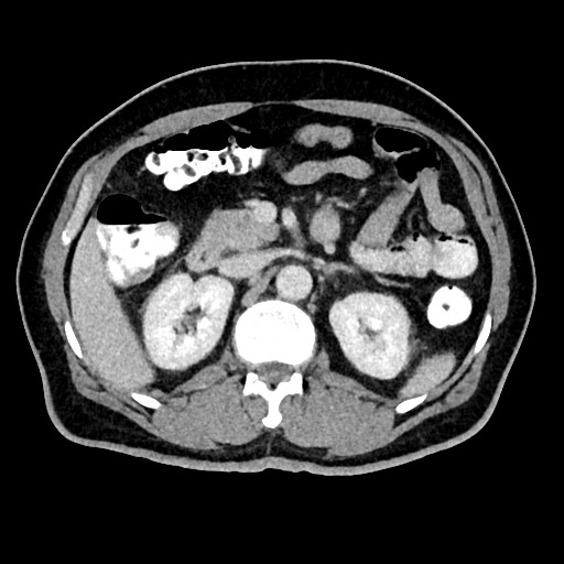 Acute appendicitis (Radiopaedia 77016-88960 Axial C+ portal venous phase 53).jpg