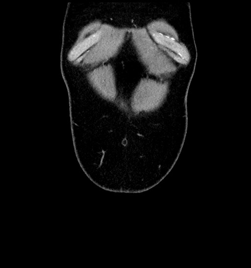 Acute appendicitis (Radiopaedia 77016-88960 Coronal C+ portal venous phase 16).jpg