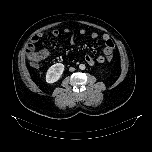 Acute appendicitis (Radiopaedia 79950-93224 Axial C+ portal venous phase 55).jpg