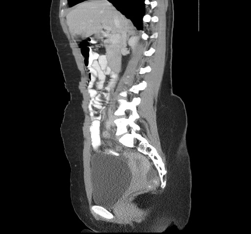 File:Acute appendicitis (Radiopaedia 9417-10099 Sagittal C+ portal venous phase 4).jpg