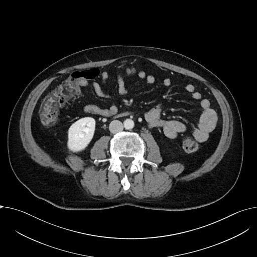 Acute appendicitis - large appendicoliths (Radiopaedia 61805-69820 Axial C+ portal venous phase 68).jpg