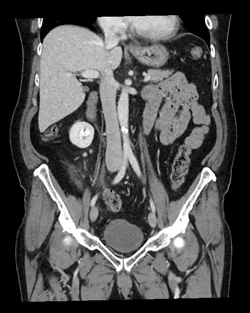 Acute appendicitis - large appendicoliths (Radiopaedia 61805-69820 Coronal C+ portal venous phase 66).jpg