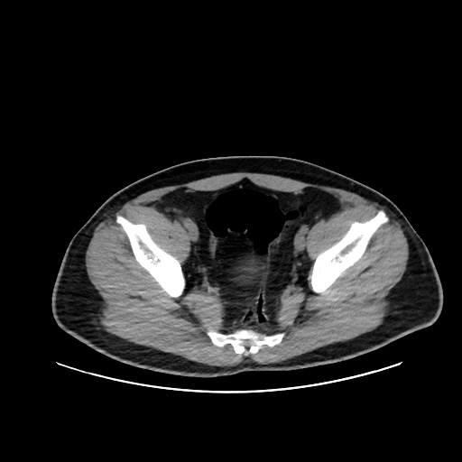 Acute appendicitis and COVID 19 pneumonia (Radiopaedia 76604-88380 Axial non-contrast 108).jpg