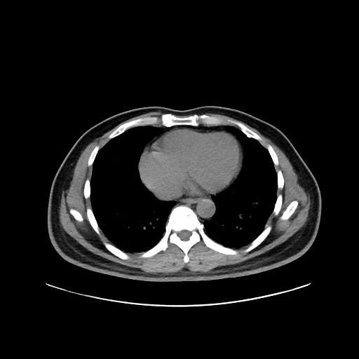 Acute appendicitis and COVID 19 pneumonia (Radiopaedia 76604-88380 Axial non-contrast 37).jpg