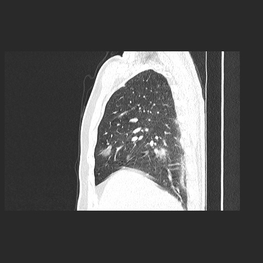 Acute appendicitis and COVID 19 pneumonia (Radiopaedia 76604-88380 Sagittal lung window 28).jpg
