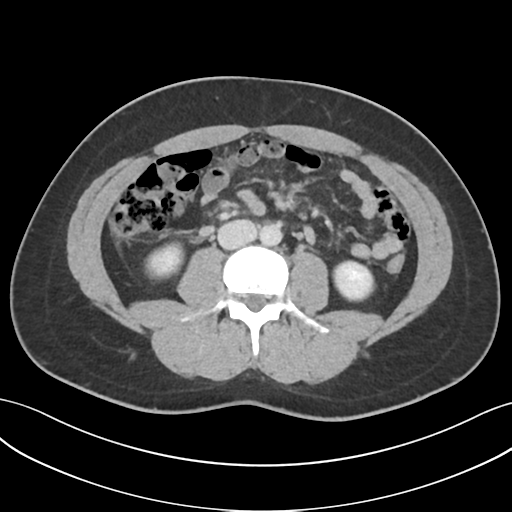 Acute appendicitis with appendicoliths (Radiopaedia 50186-55532 Axial C+ portal venous phase 42).png