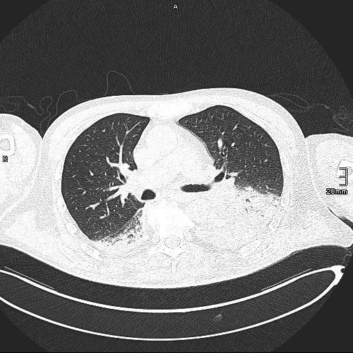Acute aspiration pneumonitis (Radiopaedia 55642-62166 Axial lung window 71).jpg