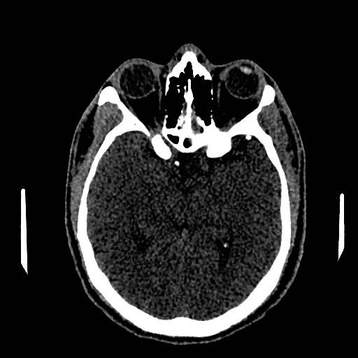 Acute basilar artery occlusion (Radiopaedia 43582-46985 Axial non-contrast 83).jpg