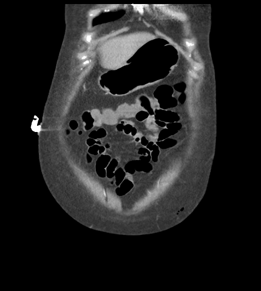 Acute bleed from gastric fundus biopsy site (Radiopaedia 35201-36737 D 12).png