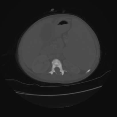 File:Acute calculous cholecystitis in patient with osteopetrosis (Radiopaedia 77871-90159 Axial bone window 21).jpg