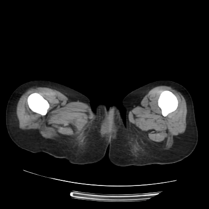 File:Acute calculous cholecystitis in patient with osteopetrosis (Radiopaedia 77871-90159 Axial non-contrast 88).jpg