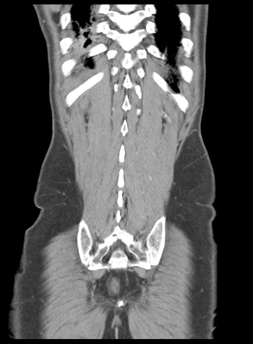 Acute cholecystitis (Radiopaedia 29814-30327 Coronal C+ portal venous phase 45).jpg