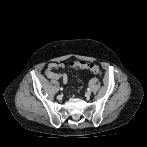 Acute cholecystitis and incidental left sided IVC (Radiopaedia 49352-54459 Axial C+ portal venous phase 120).jpg
