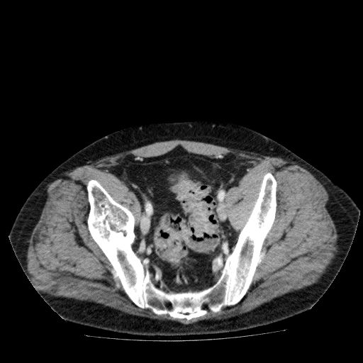 Acute cholecystitis and incidental left sided IVC (Radiopaedia 49352-54459 Axial C+ portal venous phase 130).jpg