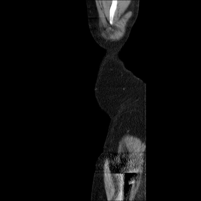 Acute cholecystitis and incidental left sided IVC (Radiopaedia 49352-54459 Sagittal C+ portal venous phase 89).jpg