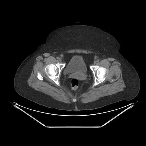 Acute cholecystitis with tensile fundus sign (Radiopaedia 71394-81723 Axial non-contrast 112).jpg