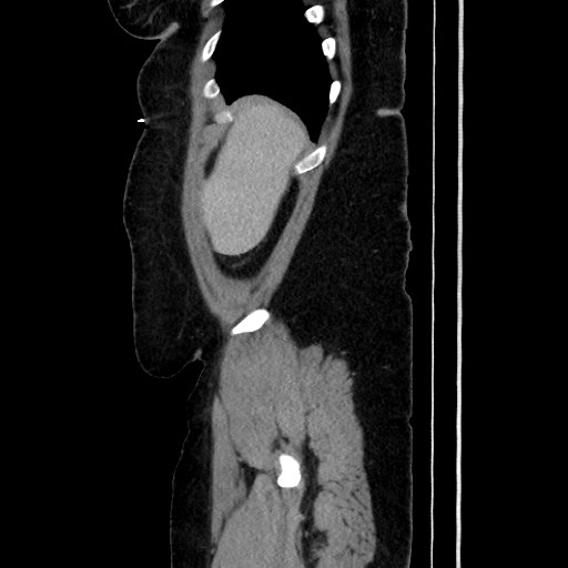 Acute diverticulitis - transverse colon (Radiopaedia 87063-103327 Sagittal C+ portal venous phase 54).jpg