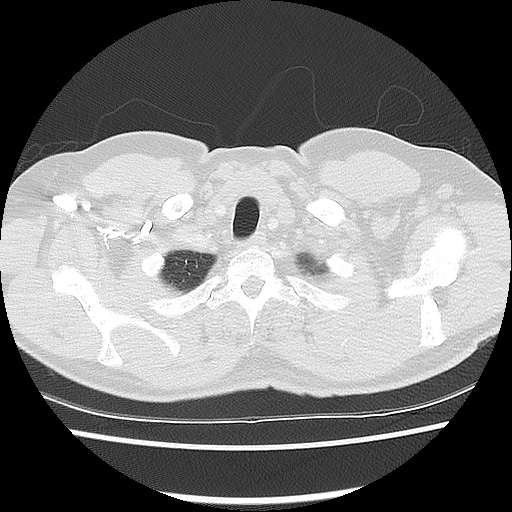 Acute epicardial fat necrosis (Radiopaedia 42327-45440 Axial lung window 9).jpg