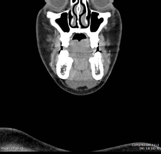 Acute epiglottitis (Radiopaedia 54375-60590 Coronal C+ arterial phase 17).jpg