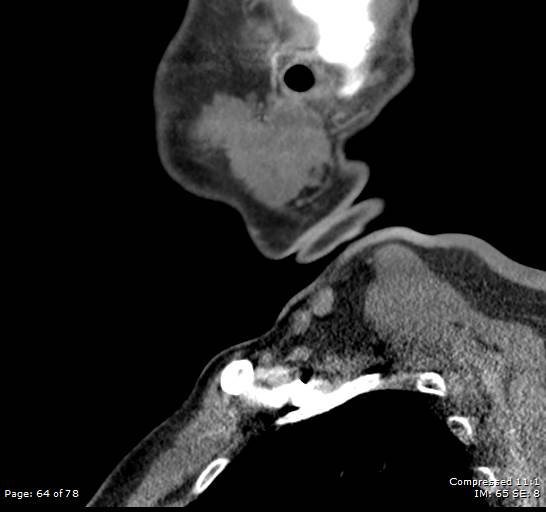 Acute epiglottitis (Radiopaedia 54375-60590 Sagittal C+ arterial phase 64).jpg