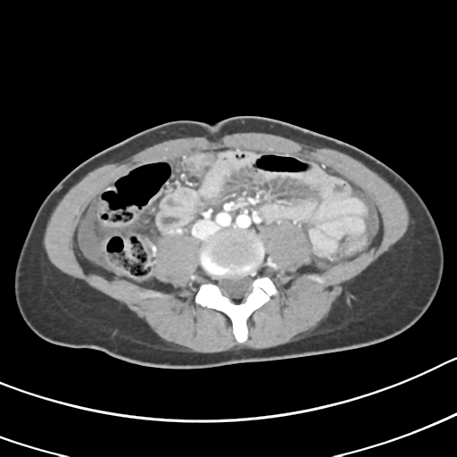 Acute gangrenous appendicitis with perforation (Radiopaedia 40152-42662 Axial C+ portal venous phase 41).png