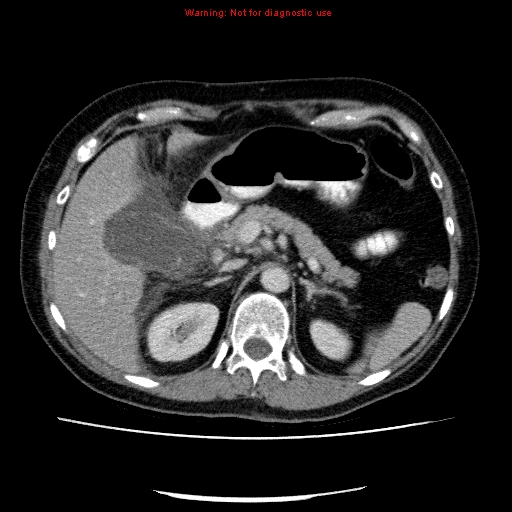 File:Acute gangrenous cholecystitis (Radiopaedia 10123-10661 Axial C+ portal venous phase 30).jpg